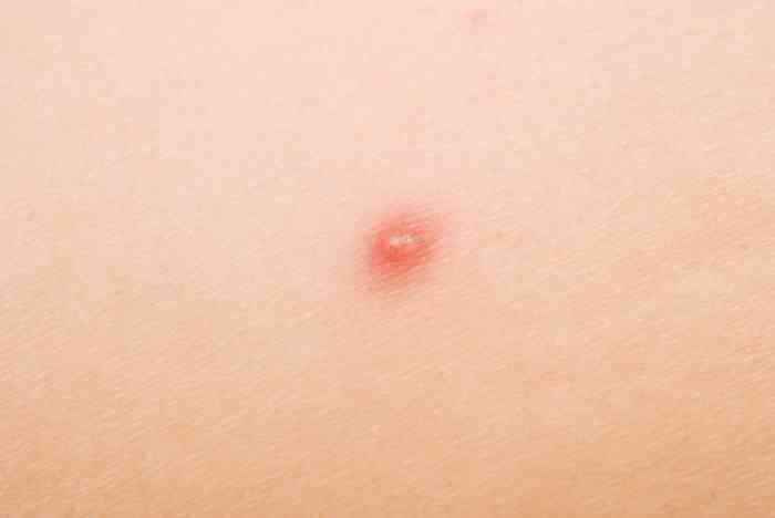 pimple