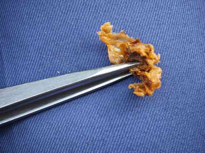 earwax 