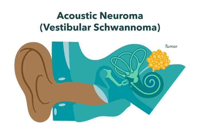 acoustic neuroma diagra