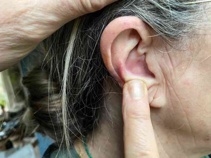 How to recognise, manage and treat an infected ear piercing | Doctor  O'Donovan explains... - YouTube