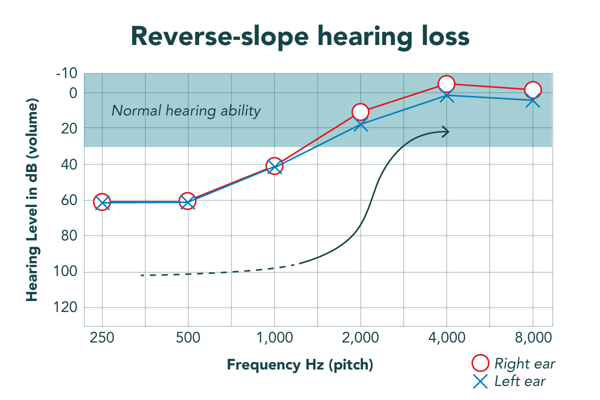 What is lowfrequency hearing loss? Causes & cure MiracleEar