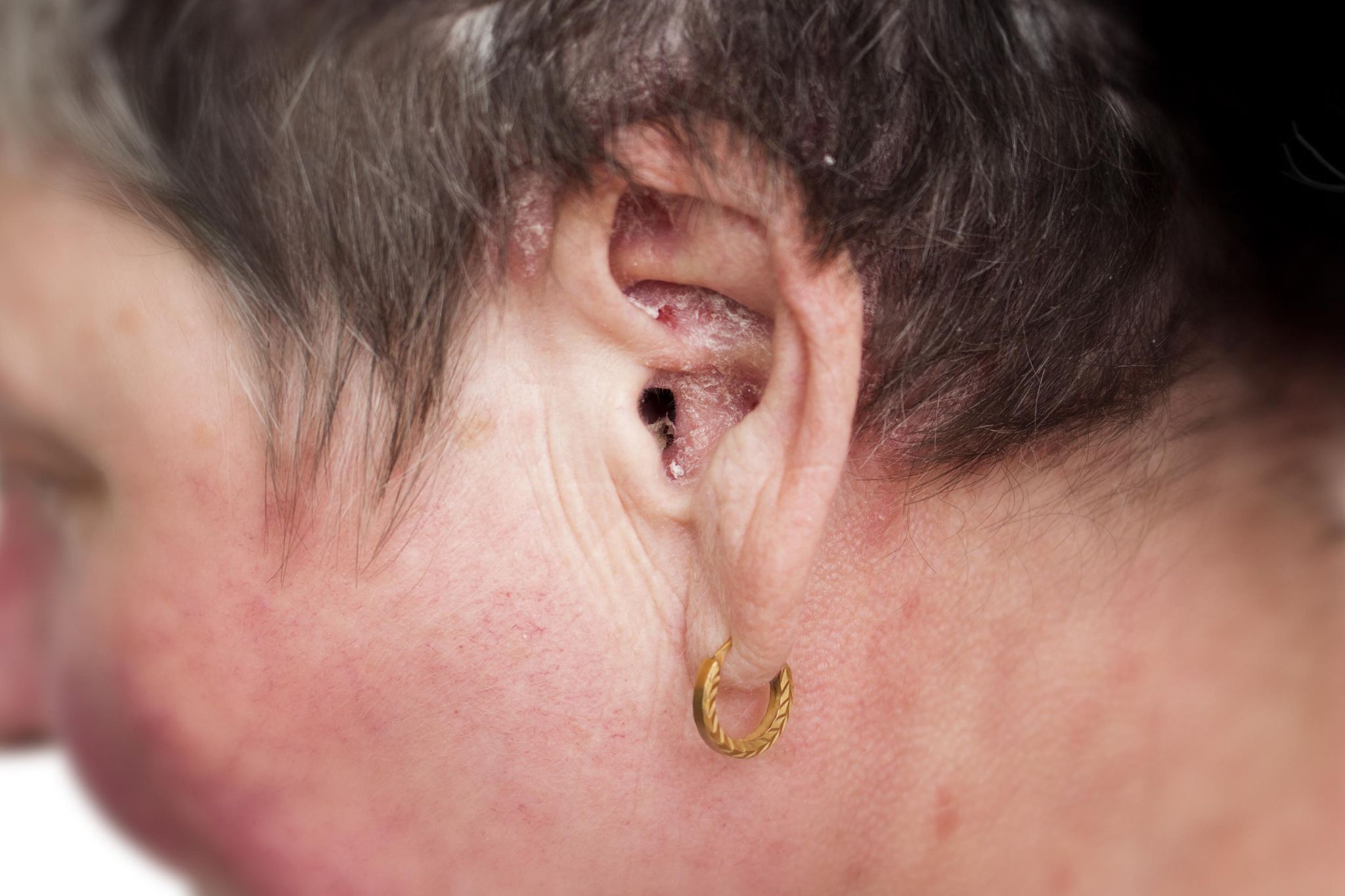 Ear Psoriasis Symptoms, Causes and Treatment Miracleear
