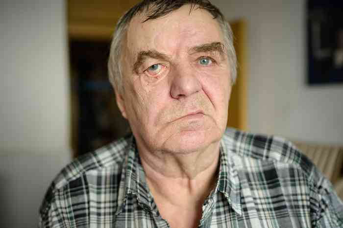 Man with Ramsay Hunt Syndrome