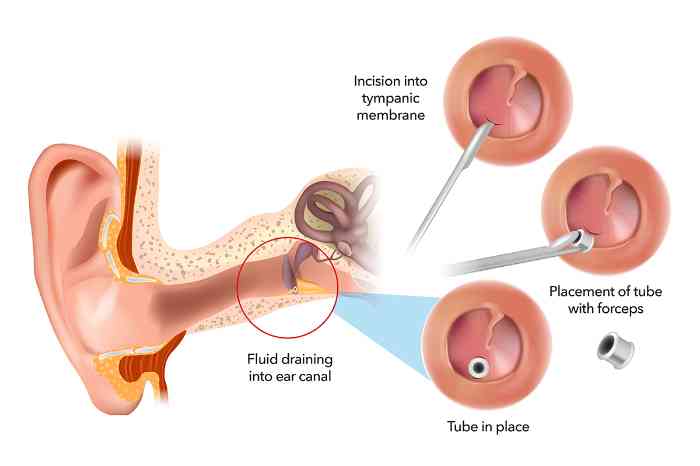 Medical illustration of ear tube placement for treating fluid buildup