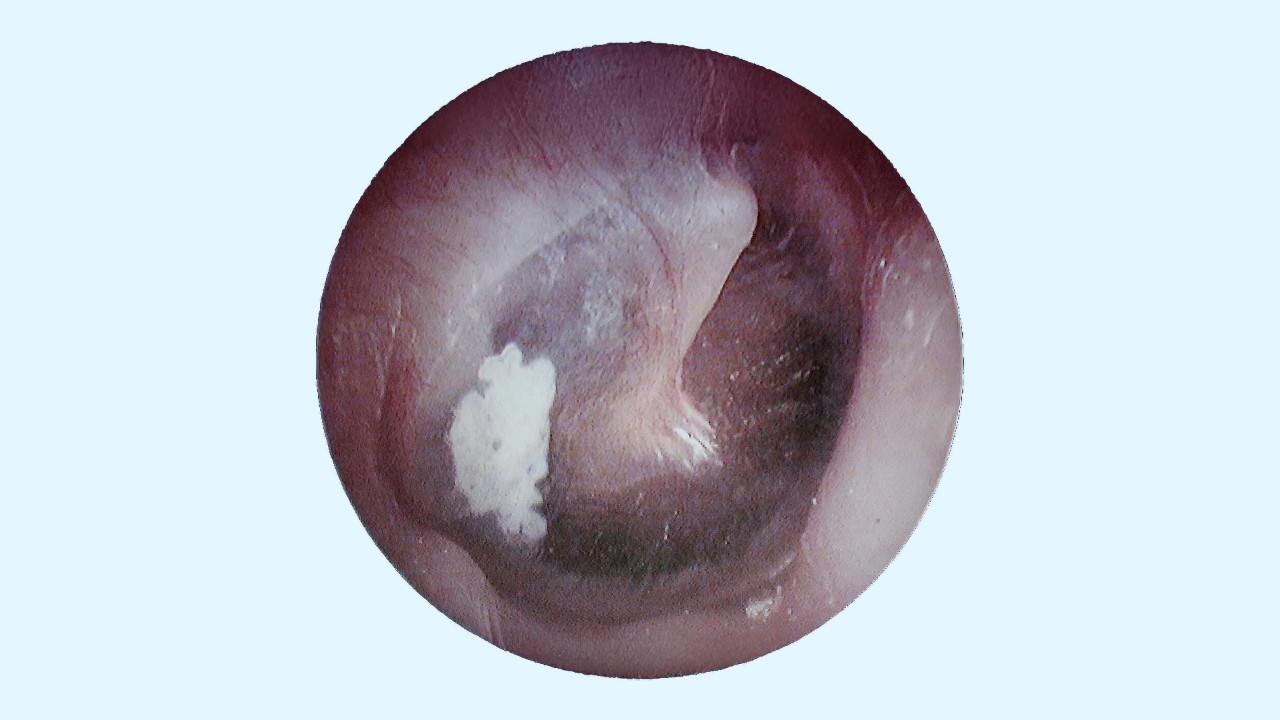 Scarring in the middle ear 